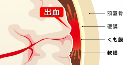 破裂 脳 動脈 瘤