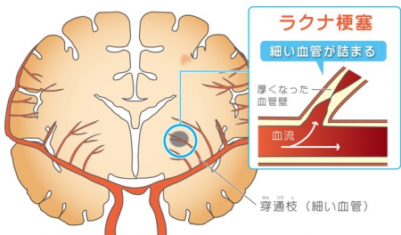 梗塞 症状 脳 軽い